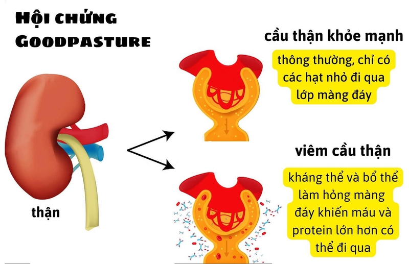 hoi-chung-phoi-than-1.jpg