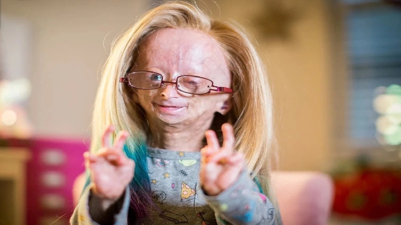 Hội chứng Progeria là gì? Triệu chứng ra sao 2