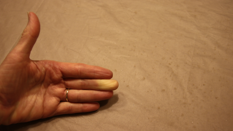 Hội chứng Raynaud 4