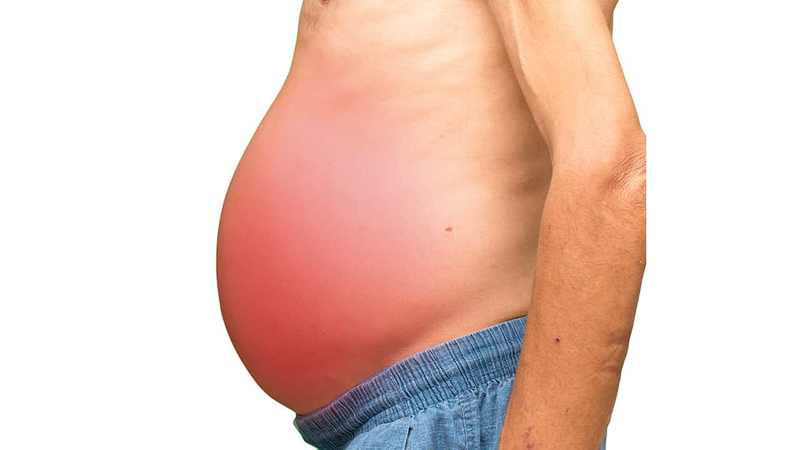 Giải mã hội chứng suy tế bào gan: Từ nguyên nhân đến cách phòng ngừa 3