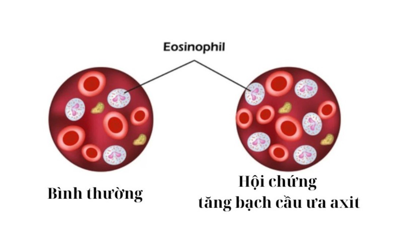 Hội chứng tăng bạch cầu ưa axit: Nguyên nhân, triệu chứng và cách chữa trị 2