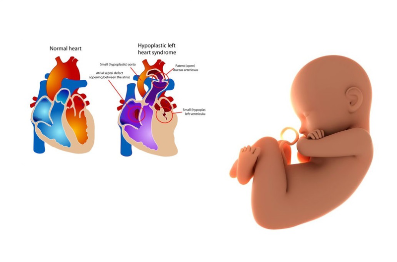 Hội chứng thiểu sản tim trái là gì? Nguyên nhân, triệu chứng, cách điều trị 1