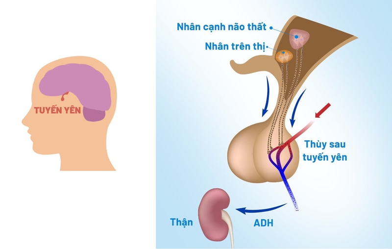 Tổng quan về hội chứng tiết ADH không thích hợp 1