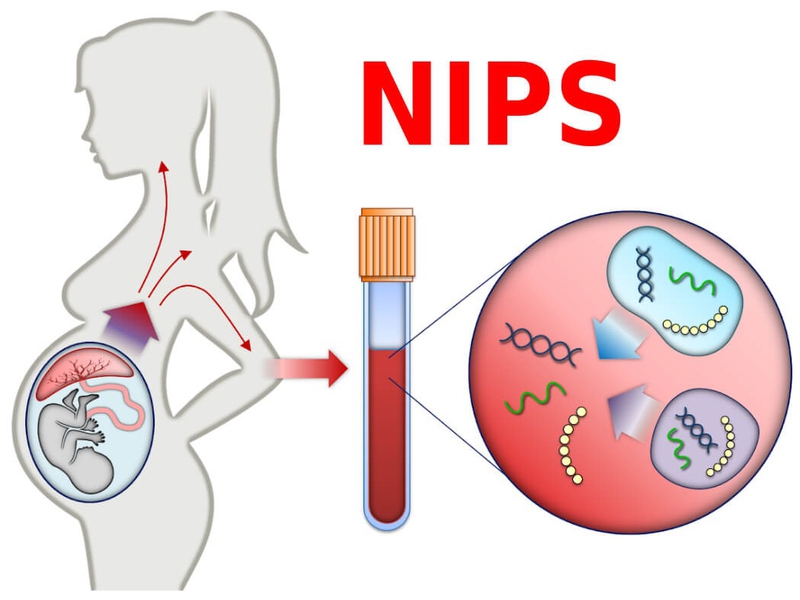 Tổng quan về hội chứng trisomy 13 3