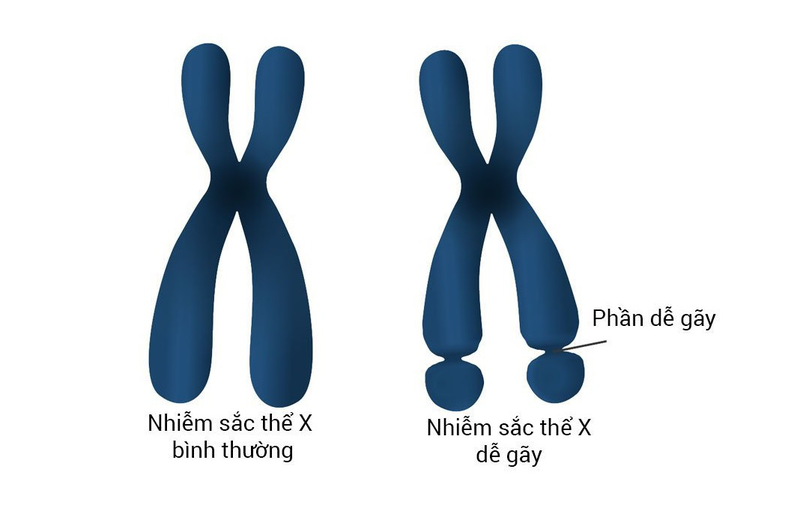 Hội chứng X dễ gãy là gì? Nguyên nhân, triệu chứng và cách điều trị  1