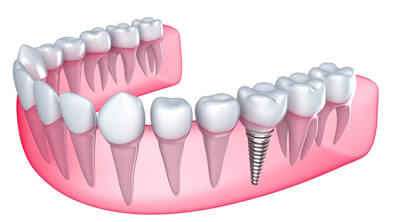 Hối hận khi trồng implant giá rẻ 1