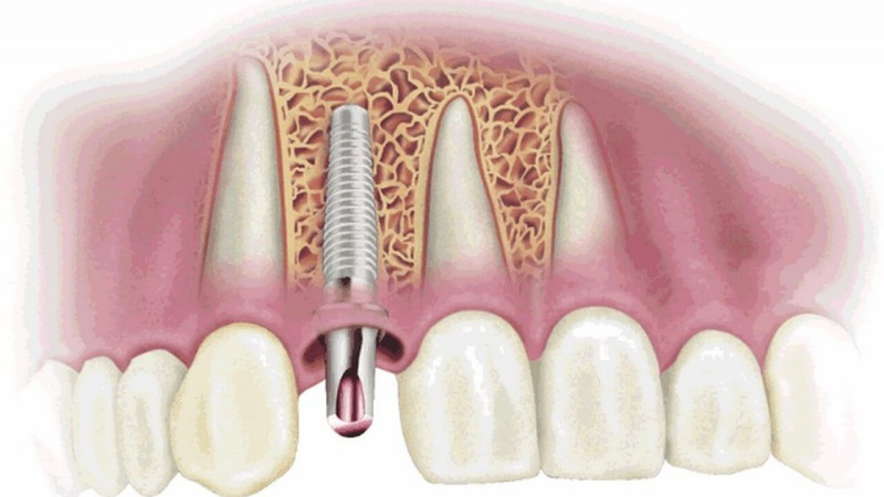 Hối hận khi trồng implant giá rẻ 3