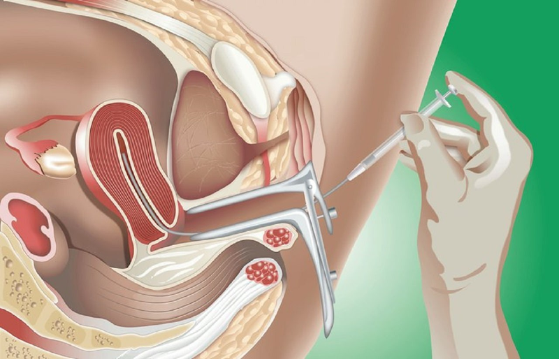 Sau bơm iui bao lâu thì tinh trùng gặp trứng? 2