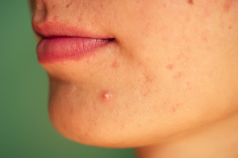 Hồng ban sau viêm: Nguyên nhân và cách điều trị hiệu quả 2