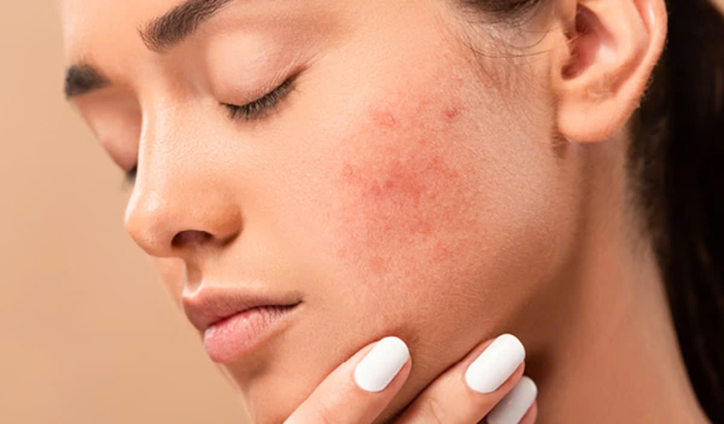 Hồng ban sau viêm: Nguyên nhân và cách điều trị hiệu quả 4