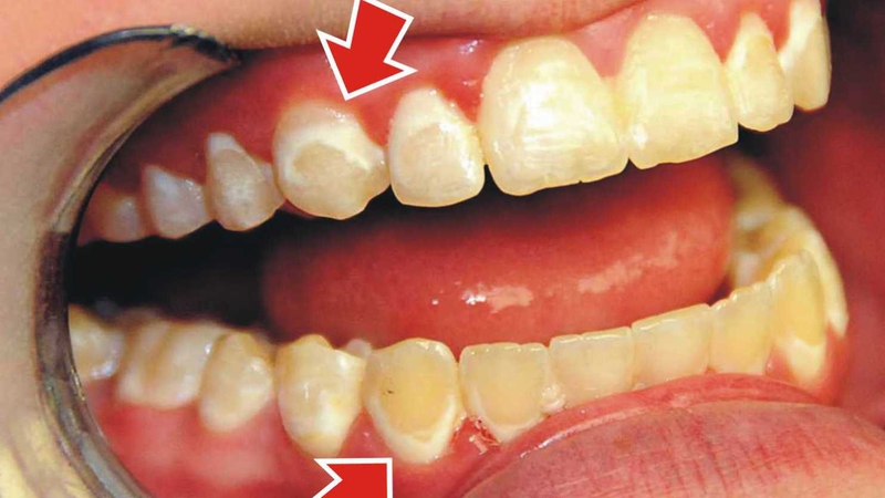 Men răng xuất hiện đốm trắng là dấu hiệu của hỏng men răng