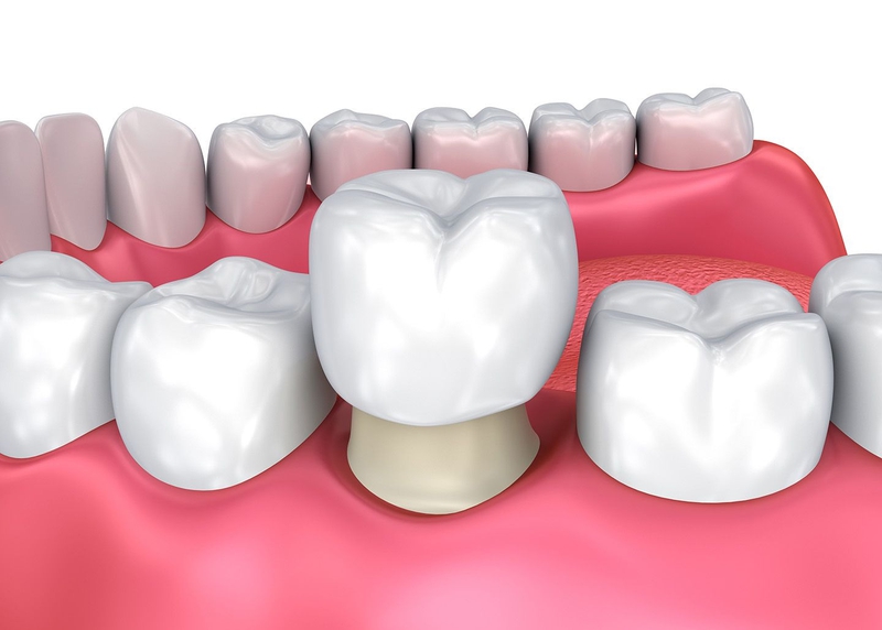 Bọc sứ khắc phục tình trạng men răng bị hỏng