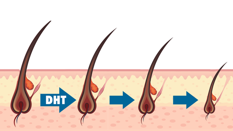 Hormone DHT là gì? Những điều cần biết về DHT và rụng tóc 1