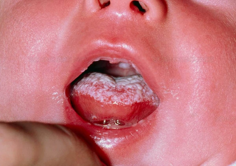 Hướng dẫn cách làm sạch lưỡi bị trắng cho trẻ sơ sinh an toàn và lưu ý 1