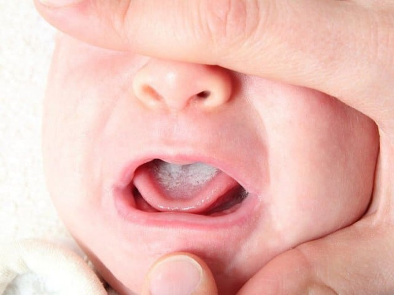 Hướng dẫn cách làm sạch lưỡi bị trắng cho trẻ sơ sinh an toàn và lưu ý 2