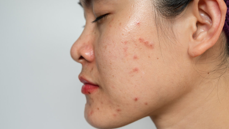 Hướng dẫn cách phân biệt da dầu và da hỗn hợp​ dễ dàng 2