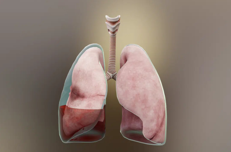 Hướng dẫn chăm sóc bệnh nhân tràn dịch màng phổi 1