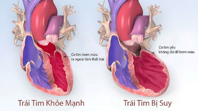 Suy tim là một trong những biến chứng của tăng huyết áp lâu ngày