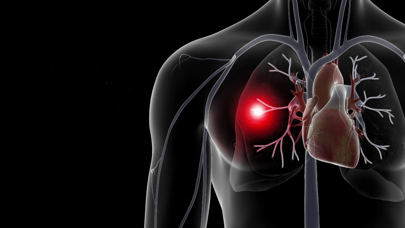 Huyết khối tĩnh mạch sâu chi dưới là gì? Những vấn đề cần biết về Huyết khối tĩnh mạch sâu chi dưới. 2.jpg