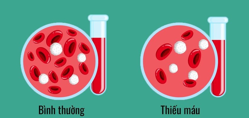 Huyết sắc tố thấp là gì? 2