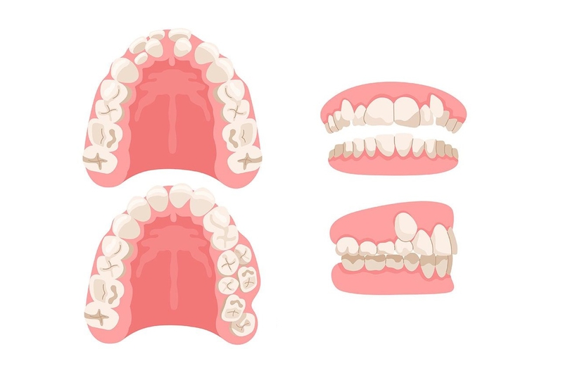 Hyperdontia – Tình trạng răng thừa bất thường hiếm gặp 1