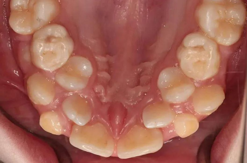 Hyperdontia – Tình trạng răng thừa bất thường hiếm gặp 2