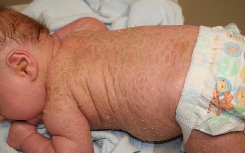 Ichthyosis 3