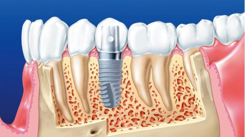 Implant Hiossen 3