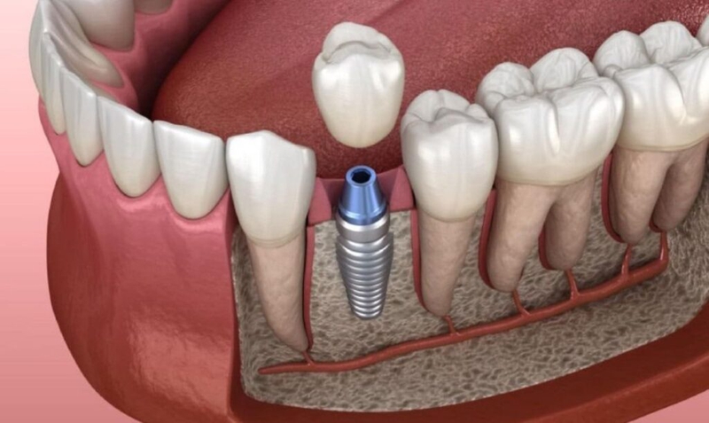 Implant Pháp có tốt không? Các loại Implant Pháp phổ biến 2