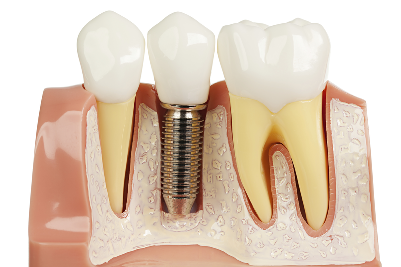 Implant Thụy Sĩ là gì? Có tốt không? - 2