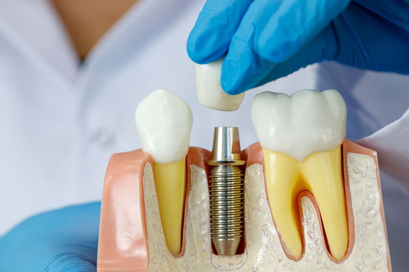 Implant Thụy Sĩ là gì? Có tốt không? - 4