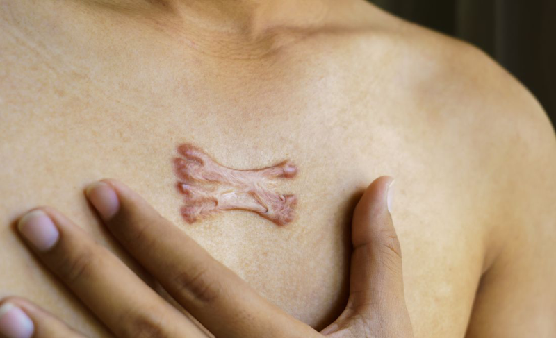 Keloid là gì? Nguyên nhân hình thành và cách khắc phục 1