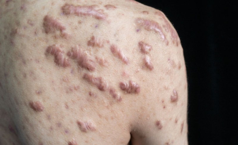 Keloid là gì? Nguyên nhân hình thành và cách khắc phục 2