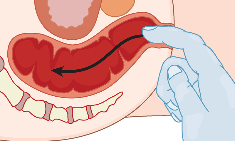 Khám hậu môn trực tràng là khám những gì? Cần lưu ý gì 1