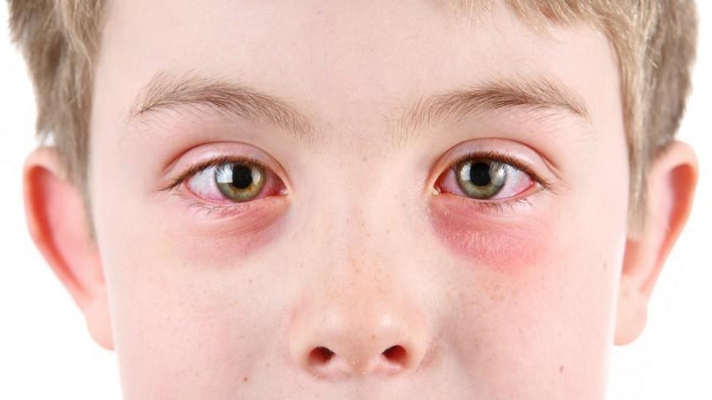 Khi bị đau mắt đỏ nên làm gì? Cách chữa đau mắt đỏ hiệu quả nhất 1