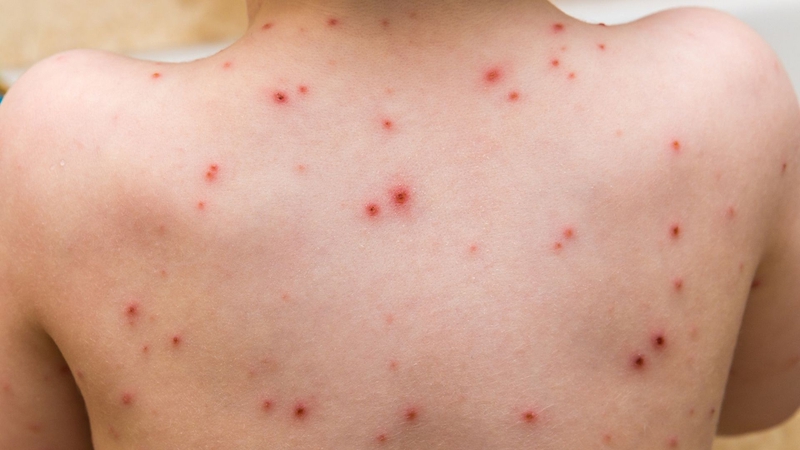 Khi bị thủy đậu có được ăn cà chua không? Nên ăn như thế nào? 4