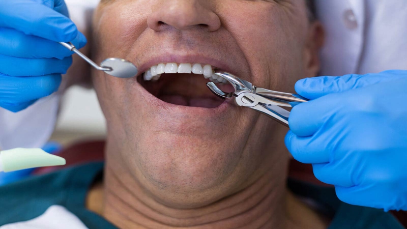 Khi nào cần phải nhổ răng số 3 để niềng răng? 1