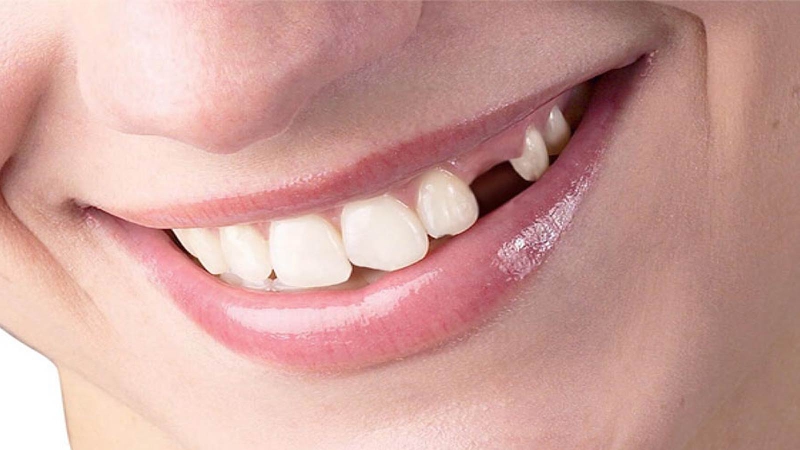 Khi nào cần phải nhổ răng số 3 để niềng răng? 3