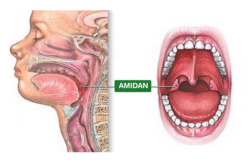 Khi nào nên cắt amidan? 1