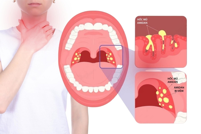 Khi nào nên cắt amidan? 2