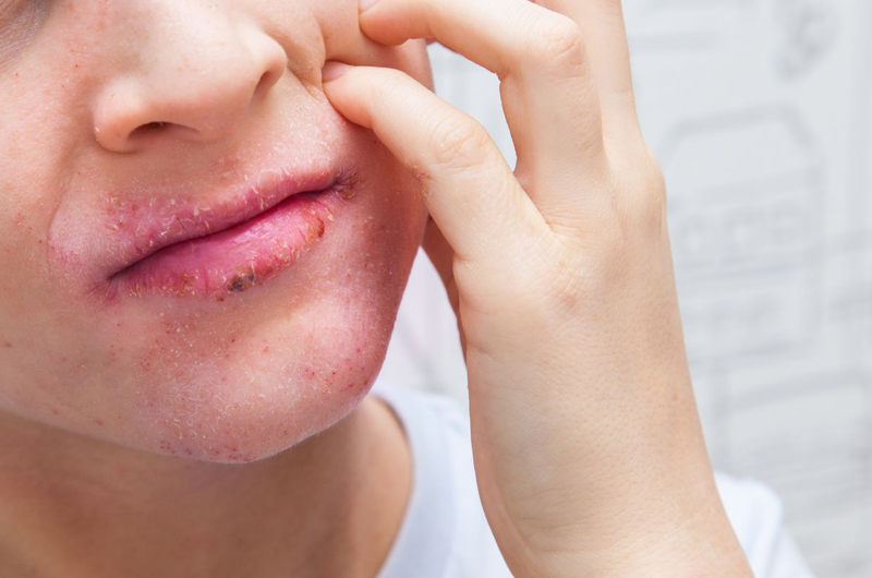 Khô da quanh miệng: Nguyên nhân, triệu chứng, cách khắc phục 2