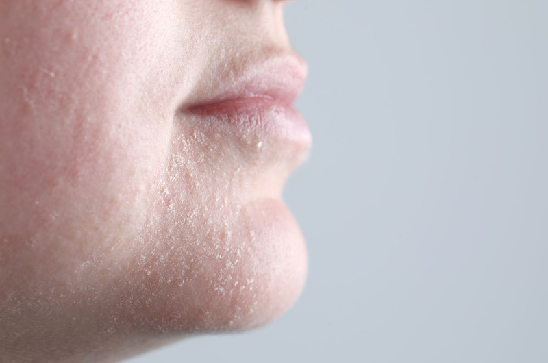 Khô da quanh miệng: Nguyên nhân, triệu chứng, cách khắc phục 3