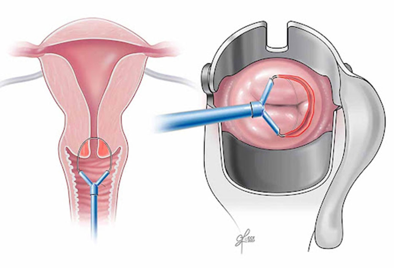 Tìm hiểu chi tiết về thủ thuật khoét chóp cổ tử cung 1