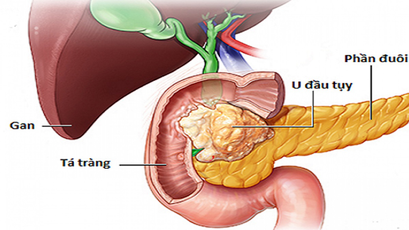 Tìm hiểu về phương pháp phẫu thuật cắt khối tá tuỵ 2