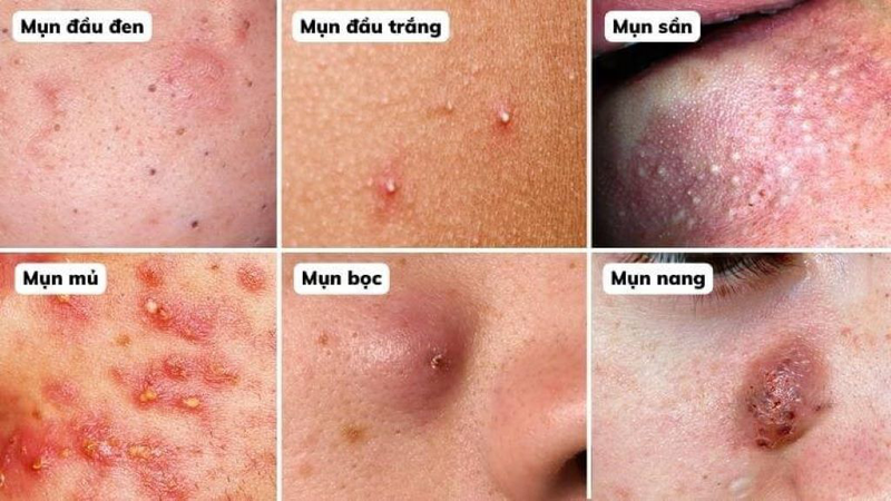 Mụn Là Gì? Các Loại Mụn Thường Gặp