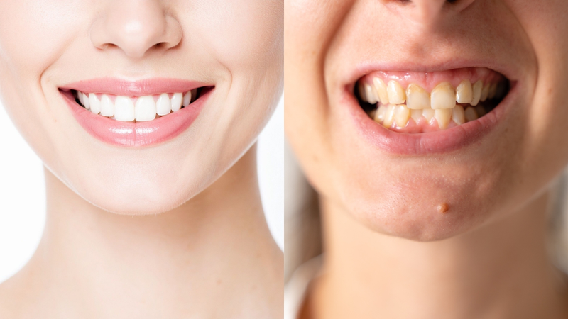 Khớp cắn chuẩn giúp răng ăn khớp hài hòa, trong khi khớp cắn sai lệch gây mất cân đối chức năng và thẩm mỹ