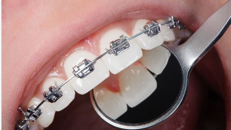 Khớp cắn ngược là gì? Nguyên nhân, dấu hiệu và cách chữa trị hiệu quả 5