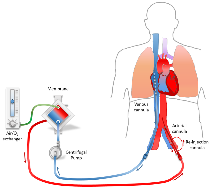 Kỹ thuật ECMO là gì? Ứng dụng trong điều trị 1