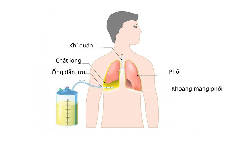 Tìm hiểu chi tiết quy trình kỹ thuật dẫn lưu màng phổi 2