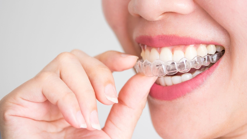 Kỹ thuật niềng răng vô hình là gì? Có hiệu quả không? 2